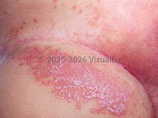 Clinical image of Diaper dermatitis candidiasis - imageId=2026908. Click to open in gallery.  caption: 'An erythematous plaque studded with pustules on the upper thigh, pink plaques in the inguinal fold and on the vulva, and erythematous papules on the lower abdomen.'
