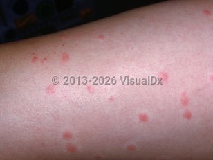 Clinical image of Cercarial dermatitis - imageId=2032752. Click to open in gallery.  caption: 'Erythematous and edematous papules, many with a blanched halo, and some tiny crusts on the leg.'
