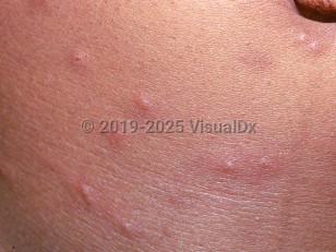 Clinical image of Flea bite - imageId=2033960. Click to open in gallery.  caption: 'A close-up of numerous tiny erythematous and edematous papules, some with central puncta.'