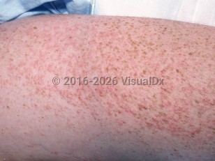 Clinical image of Miliaria rubra - imageId=2037503. Click to open in gallery.  caption: 'A close-up of myriads of erythematous papules and interspersed pustules (miliaria pustulosa).'