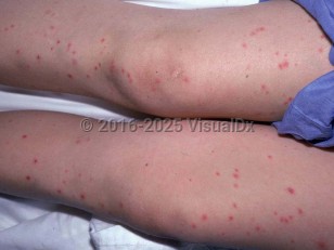 Clinical image of Trichosporon sepsis - imageId=2042393. Click to open in gallery. 