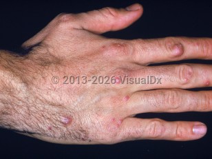 Clinical image of Sea urchin sting - imageId=2054859. Click to open in gallery.  caption: 'Numerous pink papules of varying sizes on the dorsal hand and fingers.&nbsp;'