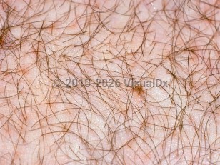 Pediculosis pubis