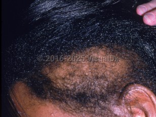 Clinical image of Congenital triangular alopecia - imageId=2152423. Click to open in gallery.  caption: 'A patch of alopecia at the temporal scalp.'