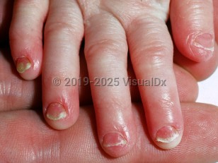 Clinical image of Trichothiodystrophy - imageId=2153102. Click to open in gallery.  caption: 'Short, broad fingernails with distal thickening.'