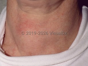 Hypothyroidism