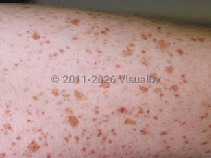 Capillaritis