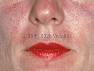 Carcinoid syndrome