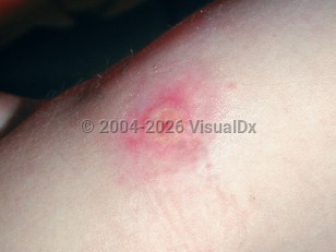 Clinical image of Tanapox - imageId=2237387. Click to open in gallery.  caption: 'A crusted pink and purpuric plaque on the upper arm.'