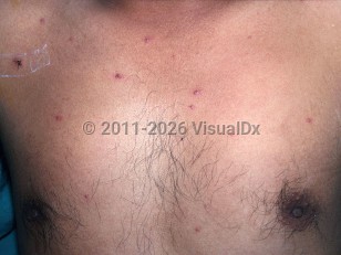 Talaromyces marneffei infection