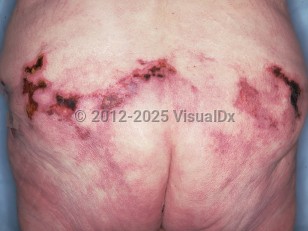 Clinical image of Cholesterol emboli - imageId=227719. Click to open in gallery.  caption: 'Retiform eschars with surrounding retiform violaceous patches and plaques on the buttocks.'