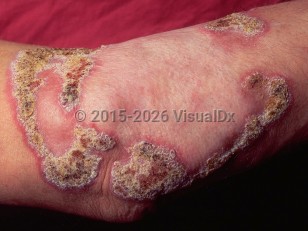 Blastomycosis