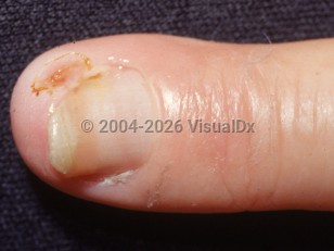 Clinical image of Acroosteolysis - imageId=2289311. Click to open in gallery. 