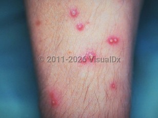 Clinical image of Listeriosis - imageId=232590. Click to open in gallery.  caption: 'Numerous pustules with surrounding erythema on the forearm.'