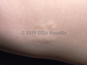 Clinical image of Buschke-Ollendorff syndrome - imageId=2330844. Click to open in gallery.  caption: 'A close-up of smooth, slightly yellowish papules and plaques.'