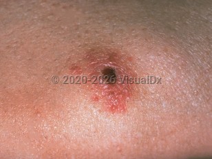 Tularemia