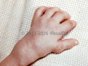 Clinical image of Farber disease - imageId=2366528. Click to open in gallery.  caption: 'Subcutaneous nodules and masses over the joints of the hand and wrist.'