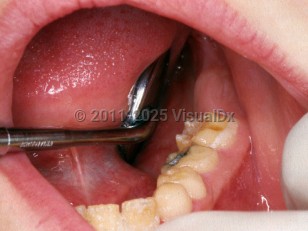 Clinical image of Amelogenesis imperfecta - imageId=2384456. Click to open in gallery.  caption: 'Pitting of the incisors and of the posterior molar.'