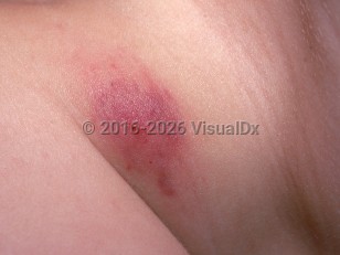 Chronic myeloid leukemia