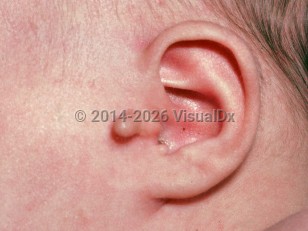 Clinical image of Accessory tragus - imageId=2398051. Click to open in gallery.  caption: 'Two preauricular papules anterior and inferior to the tragus.'