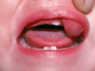 Clinical image of Oral lymphangioma - imageId=2446917. Click to open in gallery.  caption: 'A mucosal nodule arising from the upper lip.'