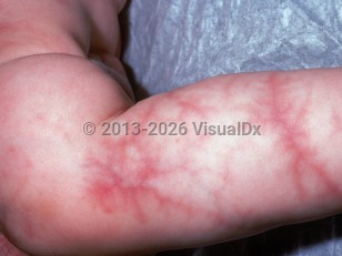 Clinical image of Cutis marmorata telangiectatica congenita - imageId=2449729. Click to open in gallery.  caption: 'Erythematous reticulate patches with a marbled appearance on the leg.'