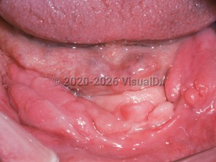 Clinical image of Denture-induced hyperplasia - imageId=2492892. Click to open in gallery.  caption: 'Numerous linear fleshy plaques at the gingival-alveolar mucosa of an edentulous patient.'