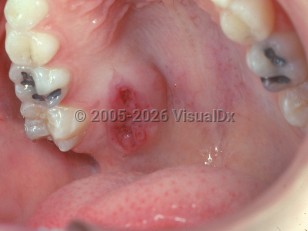 Clinical image of Malignant salivary gland tumor - imageId=2503185. Click to open in gallery.  caption: 'A mucoepidermoid carcinoma appearing as an eroded nodule on the palate.'