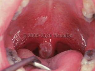 Burns of oral mucosa