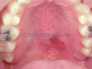 Clinical image of Necrotizing sialometaplasia - imageId=2505146. Click to open in gallery.  caption: 'Diffuse palatal swelling and focal erythema.'