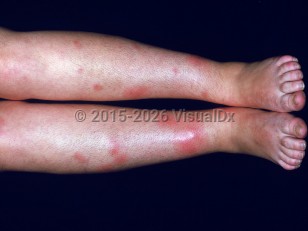 Ulcerative colitis