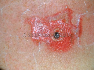 Clinical image of Vaccination bacterial infection - imageId=2539650. Click to open in gallery. 