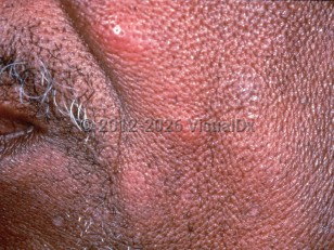 Clinical image of Kimura disease - imageId=2584062. Click to open in gallery.  caption: 'Erythematous nodules on the medial cheek.This patient also had cervical&nbsp;lymphadenopathy and peripheral eosinophilia of 16%.'