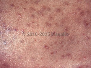 Clinical image of Pityrosporum folliculitis - imageId=2622307. Click to open in gallery.  caption: 'A close-up of several follicularly based brown papules and a few tiny pustules with some postinflammatory hyperpigmentation, in an immunocompromised patient.'