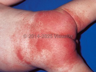 Clinical image of Diaper irritant contact dermatitis - imageId=264348. Click to open in gallery.  caption: 'Diffuse, brightly erythematous papules and plaques on the buttocks, lower back, and upper thighs.'