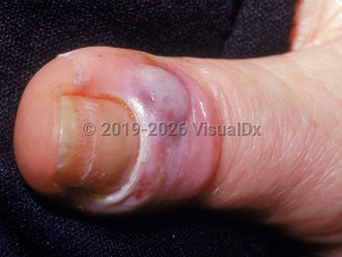 Clinical image of Bacterial paronychia - imageId=2698187. Click to open in gallery. 