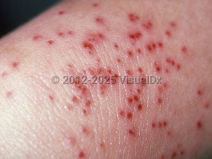 Clinical image of Eczema herpeticum - imageId=270255. Click to open in gallery.  caption: 'A close-up of many discrete and confluent, monomorphic crusts and a few outlying vesicles.'