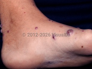 Perforating folliculitis