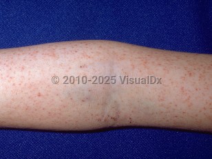 Clinical image of Rocky Mountain spotted fever - imageId=273650. Click to open in gallery.  caption: 'Myriad petechiae on the arm.'