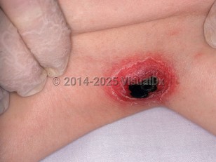 Clinical image of Neonatal bacterial sepsis - imageId=2749439. Click to open in gallery.  caption: 'A close-up of a brightly erythematous nodule with a central eschar and peripheral collarettes of scale.'