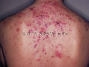 Clinical image of Acne fulminans - imageId=2760110. Click to open in gallery.  caption: 'Numerous brightly erythematous papules and nodules, many crusted, on the upper back.'