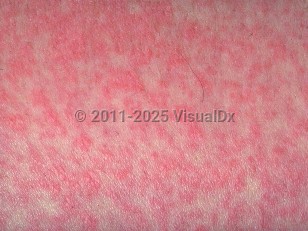 Clinical image of Viral exanthem - imageId=278979. Click to open in gallery.  caption: 'A close-up of bright pink papules becoming confluent to form plaques.'