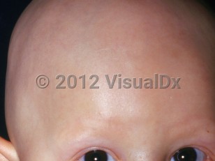 Clinical image of Atrichia congenita - imageId=2797714. Click to open in gallery.  caption: 'Complete absence of eyebrow, eyelash, and scalp hair.'