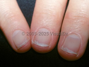 Clinical image of Onychoschizia - imageId=2798515. Click to open in gallery.  caption: 'Transverse splitting of the distal fingernails.'