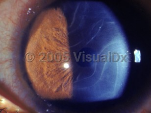 Ophthalmic Imaging image of Congenital glaucoma - imageId=2840357. Click to open in gallery.  caption: '<span>Haab's striae are swirly breaks in Descemet's membrane in congenital glaucoma.</span>'