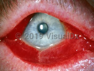 Ophthalmic Imaging image of Acute hemorrhagic conjunctivitis - imageId=2842429. Click to open in gallery.  caption: 'Extensive conjunctival hemorrhage.'