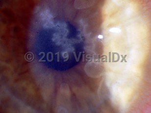 Ophthalmic Imaging image of Herpes simplex virus keratitis - imageId=2842477. Click to open in gallery.  caption: 'A dendritic corneal ulcer.'