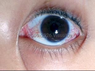 Clinical image of Ataxia-telangiectasia syndrome - imageId=2844020. Click to open in gallery.  caption: 'Conjunctival telangiectasias.'