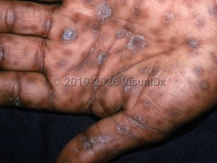 Secondary syphilis