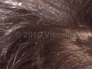 Clinical image of Pediculosis capitis - imageId=2850527. Click to open in gallery.  caption: 'A close-up of nits along hair shafts on the scalp hair.'